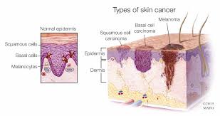 Covering the entire outside of the body, it is about 2 mm thick and weighs approximately six pounds. Skin Cancer Melanoma Causes Symptoms Treatment Health Life Media
