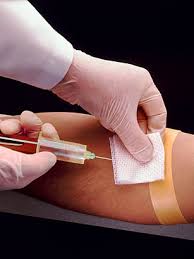Bloodletting (phlebotomy) - Top 10 Unusual Medical Treatments - TIME