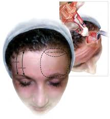 Official Newsletter of the International Society of Aesthetic Plastic  Surgery