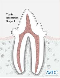 Compared with cats without oral lesions, cats with oral lesions were more likely to be older, female, taking medications, drinking city (vs well) water, and playing less often with toys. Odontoclastic Tooth Resorption Resorptive Lesions In Cats Vetlexicon Felis From Vetstream Definitive Veterinary Intelligence