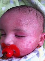 Does skin virus drops help with yeast rashes