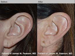 Torn Earlobe Repair By Dr James M Pearson Md Learn More At Http Www Pearsonmd Com Earlobe Rep Ear Plastic Surgery Facial Plastic Surgery Plastic Surgery