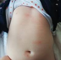 Rote Flecken Was Kann Das Sein Forum Baby Urbia De