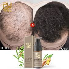 September 2, 2019 written by a staff member of hair loss in women essential oils are highly concentrated extracts of flowers, herbs, bark, roots, and leaves of different plants. Anti Loss Treatment Long Hair Growth Serum Oil Men Private Label Moisturizing Ginger Regrowth Oil For Women Fall Hair Buy Hair Growth Oil For Men Oil For Hair Fall Ginger Oil Product On