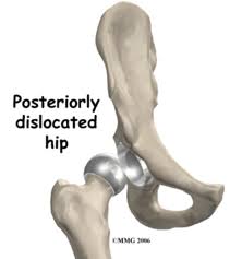 How to tell if your hip is dislocated. Https Www Waitematadhb Govt Nz Assets Documents Health Professionals Best Care Bundles Adult Total Hip Joint Replacement Dislocation Thjr Dislocation Patient Information 2 Pdf