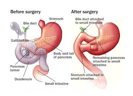 Whipple Procedure Complications Effects Success Rate
