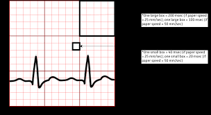 Image result for QT Interval