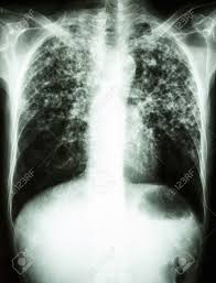 A practical manual for preventing tb, 2011. Film Chest X Ray Show Interstitial Infiltrate Both Lung Due To Stock Photo Picture And Royalty Free Image Image 26045076