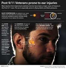 Hearing Loss: Primary Blast Injury Ear Bilateral is Accepted as a World  Trade Center-related Illness