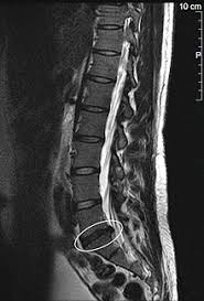 Bandscheibenvorfall Wikipedia