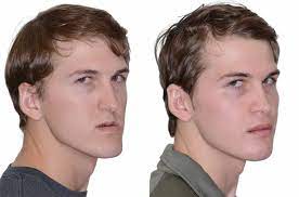 Double Jaw Surgery Kroppsdel