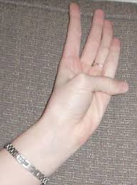 Guilt By Association Paradigm For Detecting A Silent Killer Thoracic Aortic Aneurysm Open Heart If it becomes significantly large it can lead to catastrophic complications.