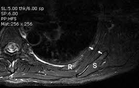 Image result for Scapulothoracic Injection