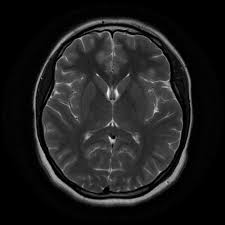 Normal Brain Mri Radiology Case Radiopaedia Org