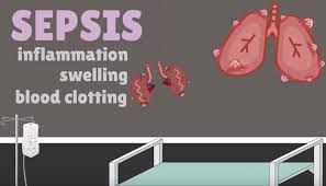 Causes of sepsis include pneumonia and urinary tract infection. The Super Sepsis Six