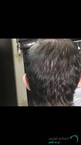 تجربتي لزراعة الشعر في عيادة دبي كوزمتك سيرجري المنتدى العربي لزراعة الشعر وعلاج الصلع