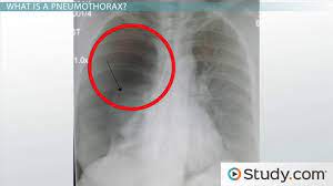 Search only for pneumothorax x ray Pneumothorax And Atelectasis Similarities Differences Causes Video Lesson Transcript Study Com