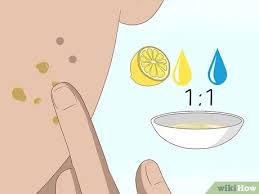 It is also a great way to naturally moisturize your skin and prevent it from producing too much they are usually caused by picking at a blemish and take much longer to heal. 4 Ways To Get Rid Of Acne Scars Fast Wikihow