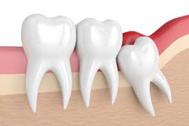 Third molars or wisdom teeth usually come out when you are 17 until 24 years old. Wisdom Teeth Monroe Ct Kids First Pediatric Dentistry Wisdom Teeth Removal Pediatric Dentist Ct