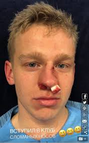 Powered by the white robot. Oleksandr Zinchenko Shows Off Bloody And Battered Nose After Being Elbowed By His Own Team Mate In Man City Win