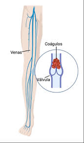 Enfermedades Vasculares Trombosis Venosas Y Sindrome Postrombotico