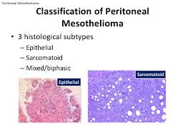 Immunohistochemical studies play an important role for the pathologist in differentiating malignant mesothelioma from neoplastic mimics, such as breast or . Peritoneal Surgery And Intraperitoneal Chemotherapy Mesothelioma Ap