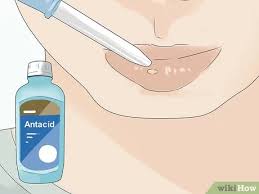 A toddler with mouth sores from the virus will experience raw, painful marks much like canker sores. 3 Simple Ways To Soothe Mouth Ulcers In Toddlers Wikihow