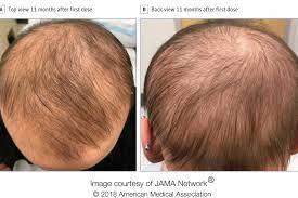 Analysts state they have refined a strategy that permits them to develop hair a remedy for sparseness could be inside sight after researchers made hair that becomes through the skin utilizing human foundational microorganisms. Updates Cures For Hair Loss 2021 Follicle Thought