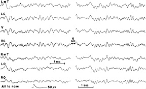Image result for Pulmonary Intoxicant