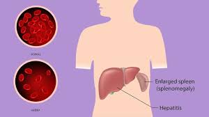 Complications That Can Result From Mono Everyday Health