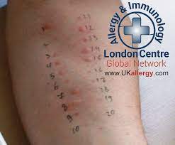 Blood testing for allergies is sometimes performed instead of skin tests. Skin Allergy Testing London Skin Prick Testing London