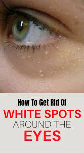 How To Get Rid Of White Spots Around The Eyes Creativity1 In 2020 Skin Tag On Eyelid How To Get Rid Skin Spots