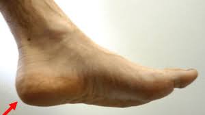 Image result for Calcaneal Apophysitis