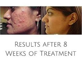 Acne Light Therapy Results After 2 Weeks