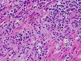 Murine models of enteroviral myocarditis suggest viral myocarditis is characterized by 3 phases. Pin On Stuff