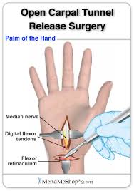 Wrist Surgery And Post Operative Rehabilitation Carpal Tunnel Carpal Tunnel Surgery Hand Surgery