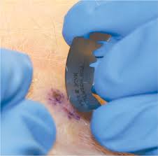 Shave biopsy wounds heal by secondary intention. Shave And Punch Biopsy For Skin Lesions American Family Physician