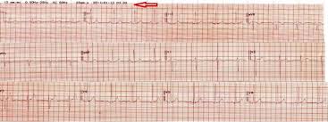 Is abnormalities in ecg normal with no heart symptoms. An Electrocardiographic Anxiety Induced Quadrigeminy And Re Assurance Sciencedirect