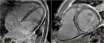 A position statement of the european society of cardiology working group on myocardial and pericardial diseases. The Radiology Assistant Ischemic And Non Ischemic Cardiomyopathy