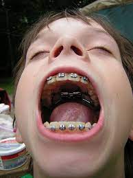 Six Tips For Preparing You Child For Braces Dental Braces Teeth Braces Braces Tips