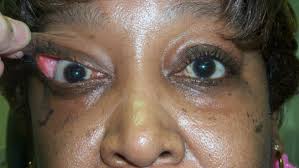 Usually what causes you eyelid to flip up exposing your eyeball, my eye feels bigger on the right than on the left, had a Floppy Eyelid Syndrome Eye Lid Laxity Ectropion Entropio Floppy Eyelid Laxity Trichiasis