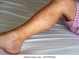 Image result for Papular urticaria