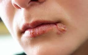 It is often confused with many other infections, such as allergic reactions. Oral Herpes Sign Risks How To Get Rid Of Cold Sores Naturally In 2018 Biogetica By Biogetica Medium