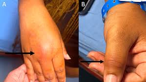 Image result for Septic Joint