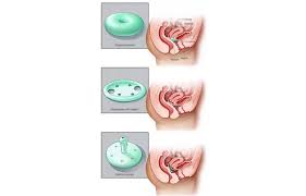 Image result for Pessary