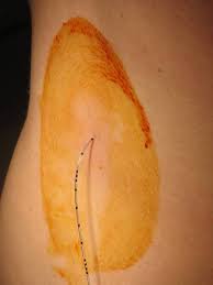 Die periduralanästhesie (von griechisch περί. Periduralanasthesie Doccheck Flexikon