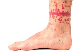 Image result for flea bite