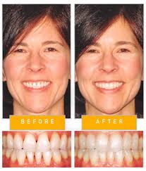 Therefore, it is essential to prioritize the treatment plans of. Treating Black Triangles Gaps And Restoring Posterior Teeth With Bioclear Injection Molding Technique Dr Carmen Burke