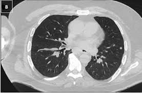 The american cancer society and other organizations have been trying to make both patients and physicians more aware and consider this diagnosis if the classic symptoms are present. Series Management Of Complex Head And Neck Cancers In The Covid Era Case 2 Penn Medicine