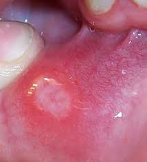 Image result for Canker sores roof of mouth